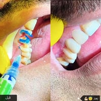 حشوات ضوئيه • مجمع اليمامه • ساعات ٤–٨م