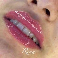 فيلر شفاه • عيادة تجميل • مجمع الكندي