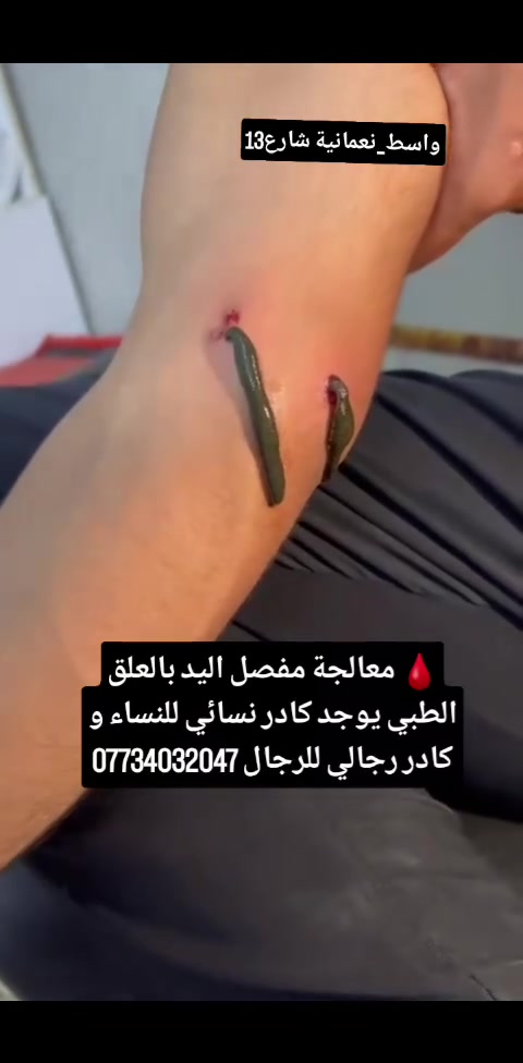� معالجة مفصل اليد بالعلق الطبي

تُستخدم المعالجة بالعلق الطبي في بعض حالات آلام ومشاكل مفصل اليد، وقد تساعد على:
� تحسين الدورة الدموية حول المفصل.
� المساعدة في تقليل الاحتقان والتورم.
� المساهمة في تخفيف الألم لدى بعض الأشخاص.
� دعم حركة المفصل وتقليل الشعور بالتيبس.
� المساعدة في تحسين وصول الدم إلى الأنسجة المحيطة بالمفصل.

� العنوان: محافظة واسط – قضاء النعمانية – شارع 13 – مقابل صيدلية علاء حسين كريم.
� يوجد كادر نسائي للنساء وكادر رجالي للرجال.
� للحجز والاستفسار: ***********

#العلق_الطبي #مفصل_اليد #آلام_المفاصل #الطب_البديل #النعمانية #واسط
#الحجامة_النسائية
#الحجامة
#الطب_البديل
#العلاج_بالحجامة
#الصحة
#العافية
#الاستشفاء
#العلاج_الطبيعي
#العناية_بالمرأة
#صحة_المرأة
#الحجامة_للنساء
#النعمانية
#واسط
#العراق
#المصطفى_للحجامة
#طب_بديل
#الوقاية
#الصحة_والعافية
#حجامة_علاجية
#حجامة_وقائية
#الجميع 
#اشارة 
#متابعين 
#الكل
