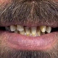 زيركون • حشوات الجذر • ميسان الماجدية