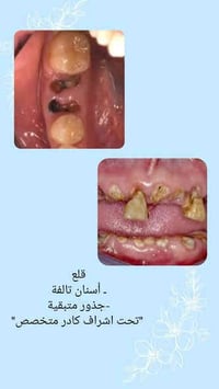 الحلة شارع اربعين • خدمات اسنان مجانية • قلع جذور