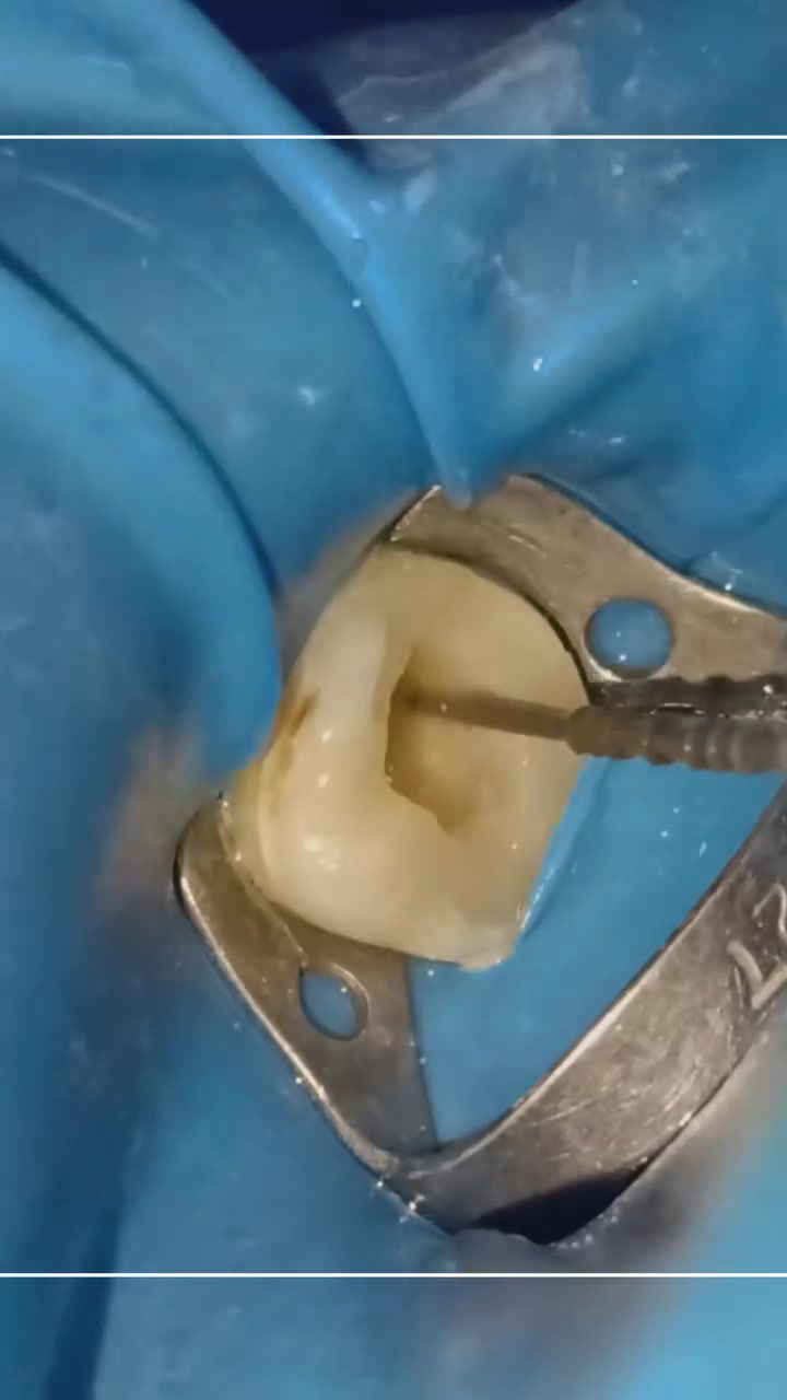 🦷 تنظيف وتعقيم قنوات الجذور
من شغل العيادة اليومي ✨
للحفاظ على الأسنان ومعالجة الألم والالتهابات بأحدث الطرق العلاجية.
🔹 تنظيف القنوات بدقة
🔹 تعقيم الجذور بشكل كامل
🔹 حشوات جذور بأجهزة ومواد حديثة
#عيادة_الدكتور_حيدر_عبد_العزيز_الطحان
🔴 للحجز والاستفسار :
مراسلة الصفحة أو الاتصال على الرقم : ***********
📍 الحلة - الثورة - مقابل مركز صحي الزهراء (ع)
