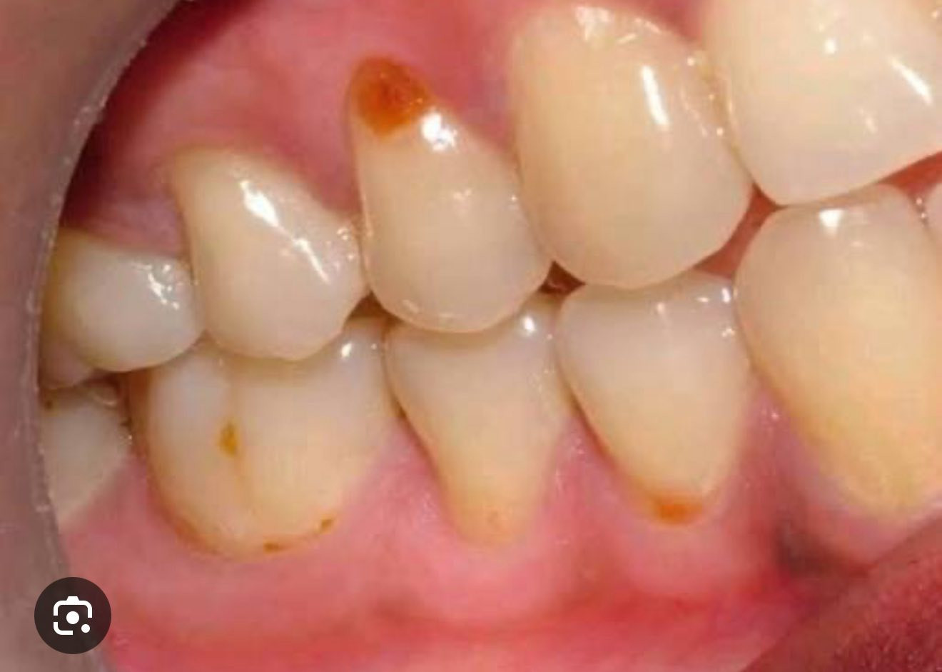 مجاناً 🔴
العنده هيج تسوسات يتواصل ع رقم  
***********
