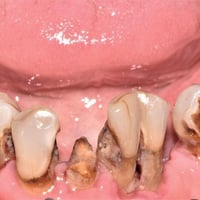 يتوفر قلع بشكل مجاني📍 للاسنان المتحركه و الجذور السوداء  للتواصل على ا...