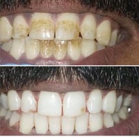 التنظيف بجهاز الايربروفي الأحدث من نوعه بعيادتنا متوفر ملاحظة/كل اللي ...