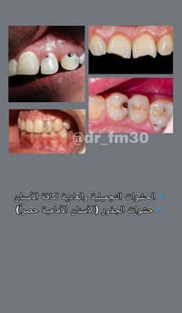 حشوات الاسنان الأمامية و تنظيف الاسنان مجاناً ✨ العلاج بـ جلسة  واحده ...
