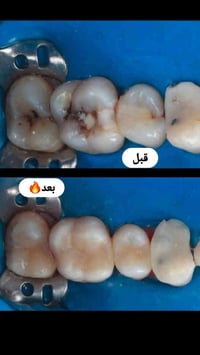 حشوات تجميليه وبجلسه واحده من داخل عيادة المسك👌🏻🔥  📍عنوانا : الحسينيه_...