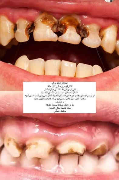 السلام عليكم 
اللي يحتاج علاج يخص اسنانة من حشوات وقلع وتنظيف وتعويض الاسنان المفقودة بطقم كامل او للاطفال قلع وتنظيف وحشوات ، يتواصل وياية احجزلة موعد بالمستشفى التعليمي لجامعة الكوفة 
للتواصل على حساب الفيس بوك 
او  واتس آب ***********
