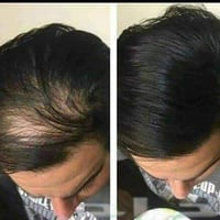 منع تساقط • تطويل شعر • تكثيف شعر