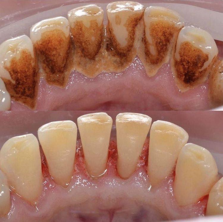 ❗️❗️
السلام عليكم ،،الي محتاج حشوات او تنظيف التكلسات او قلع اسنان او بقايا جذور او فاقد اسنان و يحب نسويله طقم يتواصل وياي  عالرقم ***********

علماً ان العلاج مجاني و بأشراف اطباء اختصاص❕

العنوان : عيادات جامعه الكفيل شارع الاسكان في النجف الاشرف
