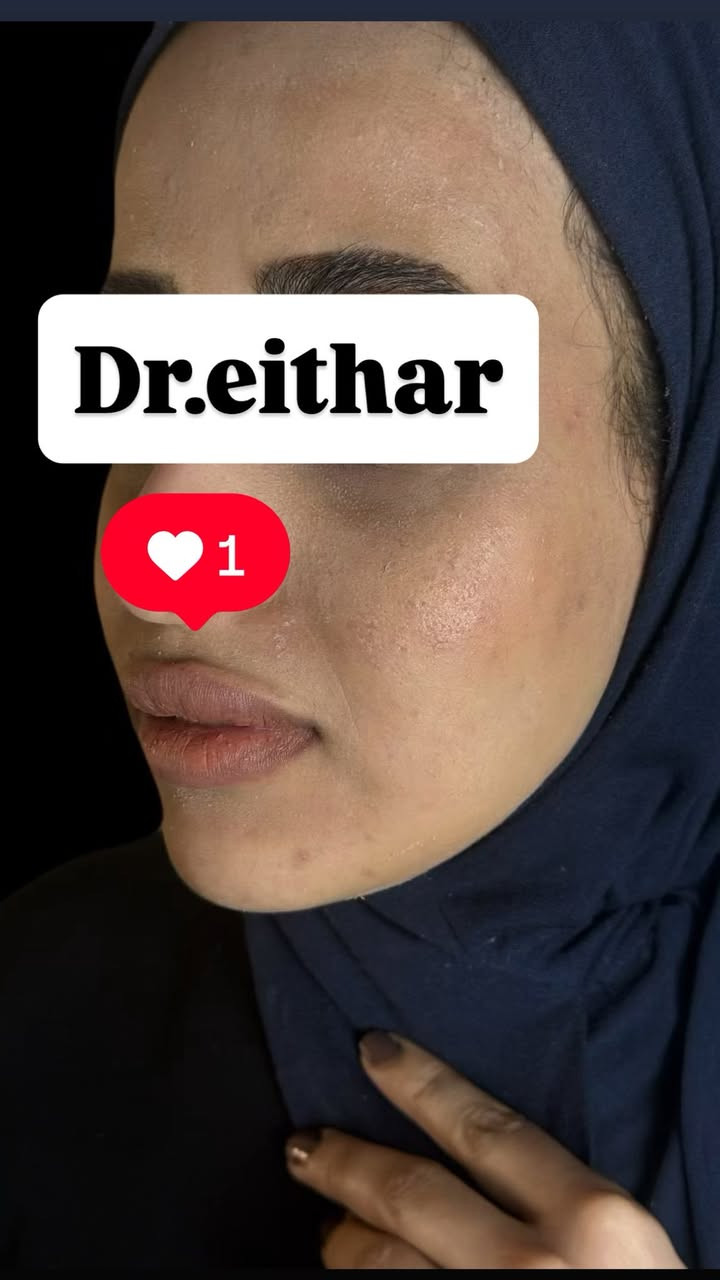 استداره وجه كامله بطريقة الشد (لفتنك وجنات واصداغ  وتدوير الفك والذقن  ونظاره  )وتعديل ع حقن سابق للشفه بدون تذويب

لاحضو شون الوجه  قبل الحقن ضعيف ونازل والذقن مابي تحديد وخسفات بالاصداغ  والشفه بس امتلاء ومابيهه رسمه قبل التعديل 
وبعد الحقن انرفع وانسحب واتحدد بطريقه بينت الوجه انعم وانثوي 👌

عروض العيد نزلتهه الكم بالستوري بالهايلايت مستمره لحد العيد  🔥

د.ايثار سامي عبد الامير
الكوت_واسط _الهوره_مجمع القبطان

الحجز***********

