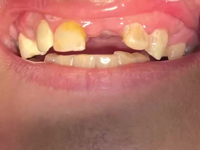 🔹 حالة اليوم: تركيب أسنان زاركون  لإحدى مراجعاتنا الكرام.

👩‍⚕️ الدكتورة هند عبد كزار التميمي
📅 أيام التواجد: الثلاثاء – الأربعاء – الخميس
⏰ وقت الدوام: من الساعة 3:30 عصرًا إلى الساعة 7:00 مساءً

📍 العنوان: شارع الأطباء – مقابل صيدلية سعيد بن الجبير
📞 للحجز والاستفسار: ***********

نرحب بكم في أي وقت، ويسعدنا تقديم أفضل خدمات طب وتجميل الأسنان. 🌿
