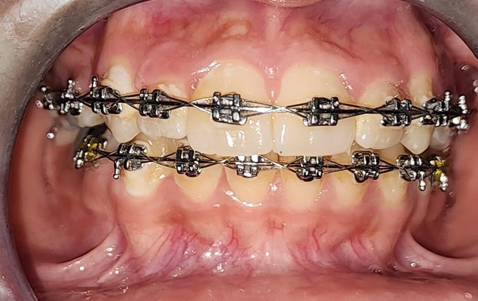 رفع التقويم بعد ترتيب وتعديل الاسنان للفكين
طبيب الاسنان الاختصاص د.عمار عباس
ماجستير تقويم وتجميل الاسنان M.S.c ortho
بكلوريوس طب وجراحة الفم والأسنان B.D.S
بغداد الشعب شارع عدن قرب  مركز شرطة الشعب  مدخل سوق شلال عمارة باريس الطابق الاول دوام العيادة جميع ايام الاسبوع ما عدا الجمعة عطلة من ٤ ل ٨  بدون حجز مسبق الدخول حسب اسبقية الحضور للعيادة الفحص والمعاينة مجاني للاستفسار ***********
