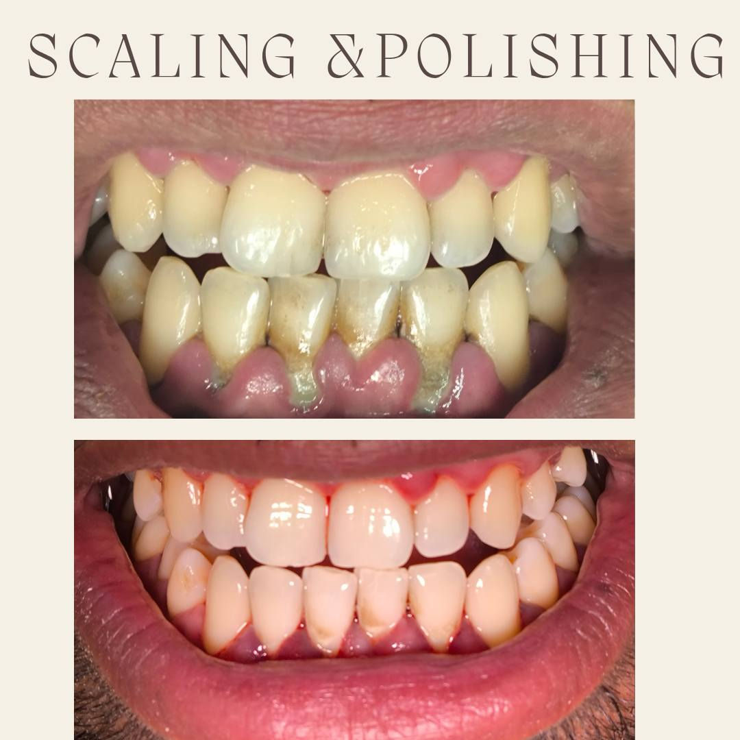 ✨العلاج مجاني 🦷
فحص الاسنان_حشوات ضوئية _تنظيف الاسنان_قلع الاسنان
📍 بغداد _القادسية_جامعة ابن سينا للعلوم الطبية _ مقابل بلدية الرشيد

للحجز:***********
