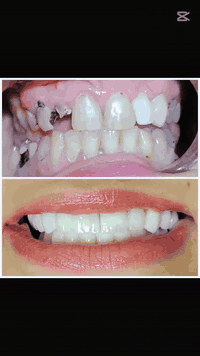 ابتسامه زاركون ايماكس للفكين  بعد معالجة جميع الاسنان من حشوات وقلع و وصلنا لهاي النتيجة الحلوة الف عافية لمراجعتنا

للحجز :***********

العنوان :بعقوبة-التحرير الفلكة الاخيرة مقابل مركز صحي التحرير الثاني مجاور مجمع الهيبة العائلي

#اجعل_ابتسامتك_افضل
#مع_عيادة_الدكتورةميس
