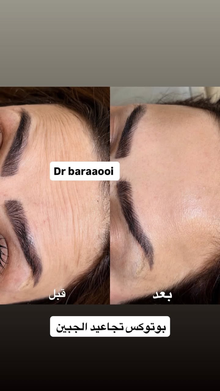 عيادة التجميل الاولى في الحسينية وتحت إشراف أطباء مختصين وبأنسب أسعار عنوان العيادة الجريخي مجمع الصدرين الطبي الطابق الثاني مقابل مطعم جكن اوسلو 
عيادة اوليفيا للتجميل 
للحجز والاستفسار واتساب ***********
