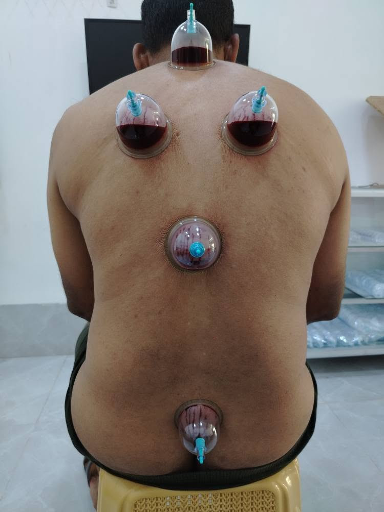 يتكون دم الحجامة (المستخرج عبر الحجامة ) من سوائل وتركيبات تختلف عن الدم الوريدي العادي.
 يحتوي في الغالب على كريات دم حمراء هرمة، ونسبة عالية من السموم والمعادن الثقيلة، إضافة إلى أخلاط وترسبات ضارة تسعى الحجامة لإخراجها من الجسم.إليك التفاصيل العلمية لمكونات هذا الدم وخصائصه:كريات الدم الحمراء: يتركز في دم الحجامة عدد كبير من كريات الدم الحمراء التالفة أو "الهرمة" التي انتهى عمرها الافتراضي وتكون محملة بالشوائب مختصة هذا ما وجده العلماء في الدم المستخرج بعد الحجامة  كما يحمل نسبة هيموغلوبين مركزة.السموم ومخلفات الأيض: أثبتت الأبحاث أن دماء الحجامة تحتوي على مستويات أعلى بكثير من السموم، مثل حمض اليوريك، والأمونيا، واليوريا مختصة هذا ما وجده العلماء في الدم المستخرج بعد الحجامة والتي قد تصل لسبعة أضعاف الحد الطبيعي الموجود في الدم الوريدي.المعادن الثقيلة: يساعد هذا الإجراء في التخلص من المعادن الثقيلة والضارة المترسبة في الأنسجة، وتخفيف مستويات بعضها (مثل الكادميوم والألومنيوم) في الجسم تأثير العلاج بالحجامة الرطبة على مستويات بعض المعادن الثقيلة في الدم.خلايا الدم البيضاء: يلاحظ أن نسبة خلايا الدم البيضاء في دم الحجامة أقل بكثير منها في الدم الطبيعي، مما يعني توفير حماية أكبر للخلايا المناعية لتبقى نشطة وتعمل بكفاءة داخل الجسم مختصة هذا ما وجده العلماء في الدم المستخرج بعد الحجامة الرمادي, الأنبار


**إذا كنت صاحب هذا الإعلان وتريد حذفه لأي سبب، رجاءا أرسل رسالة إلى الدعم الفني**