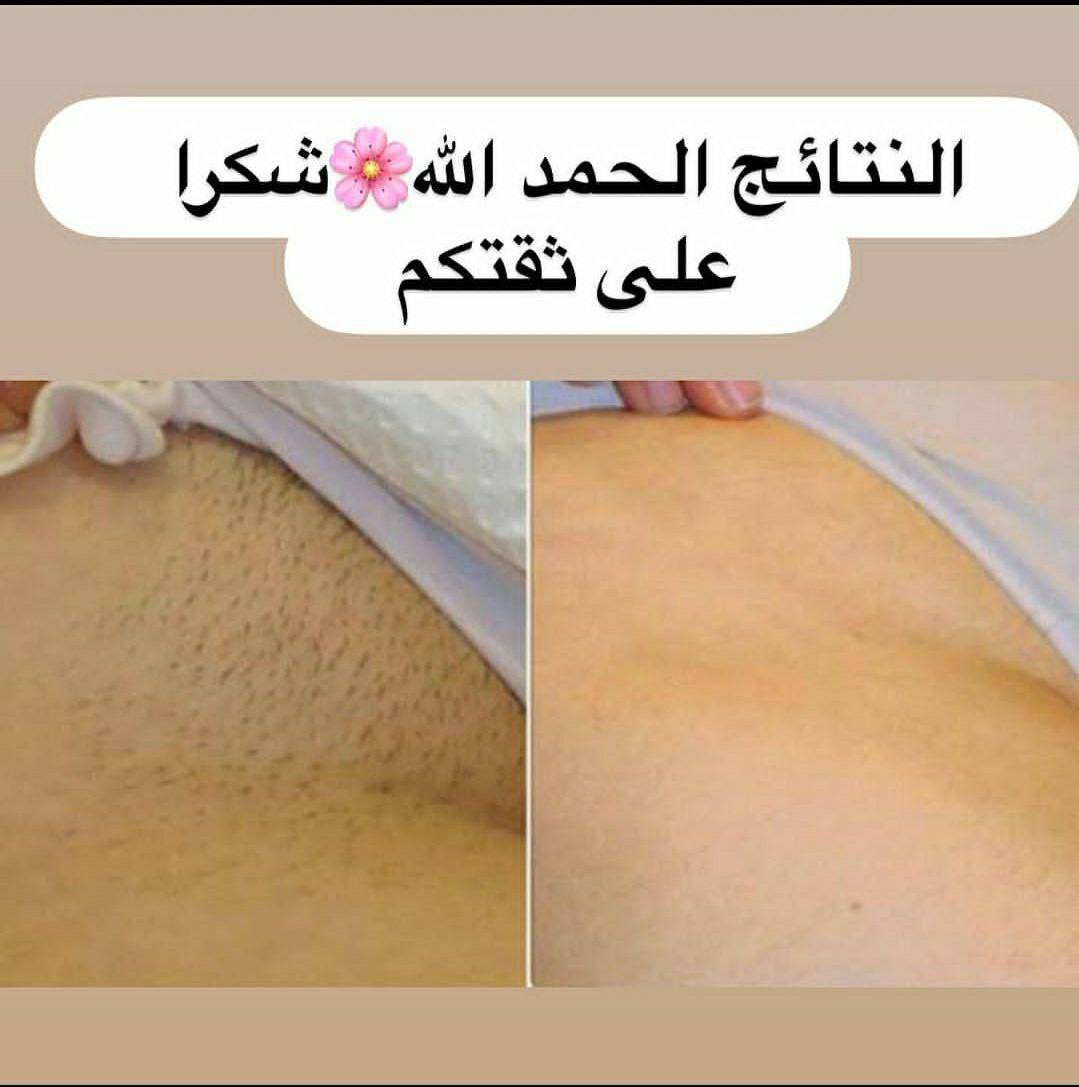 زواجج قرب وتردين تستغلين هاي الفتره وتخلصين من الشعر نهائيااا
ومتگدرين تروحين مراكز تجميل
وفرتلج الحل ليزر منزلي رهيييييب
بتقنية IPL 🌸
يخلصج من الشعر نهائياااا
وبدون اي اظرار ويكون باااارد 🥶
ابد ميحرگ المنطقه 
ويحتوي على 500الف ومضه يكفيج سنين
وسعرررررره صدمه 🔥ومنااااااسب للجمييييع 
وتوصيييييل مجاااااني لجميع محافظااات العراق 😍
#ليزر_منزلي


**إذا كنت صاحب هذا الإعلان وتريد حذفه لأي سبب، رجاءا أرسل رسالة إلى الدعم الفني**