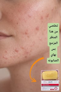 صابونة ACM • كلف • حبوب