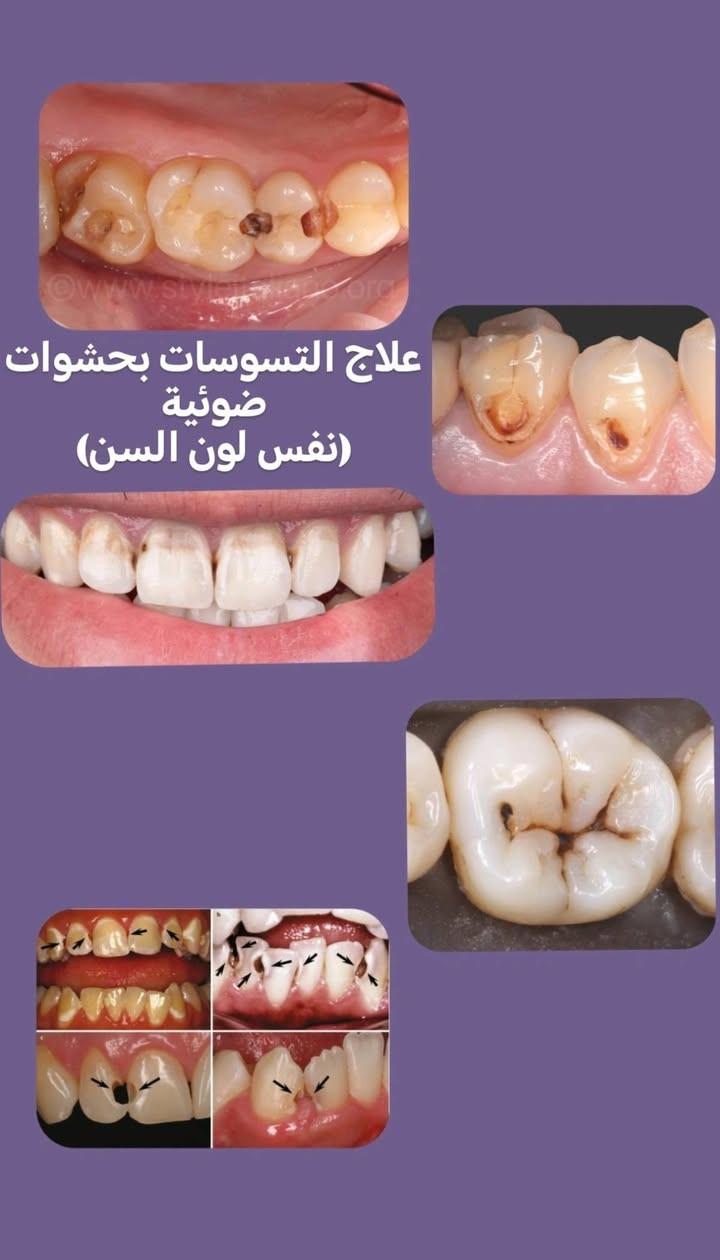 يتوفر علاج بحشوة ضوئية للحالات الاتية
العلاج مجاني و بأشراف اطباء مُختصين 
 في عيادات كلية السلام 
للتواصل ***********
