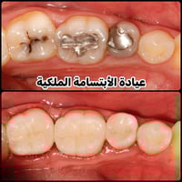 حشوات تجميلية • تبديل حشوات معدنية • بغداد سبع البور