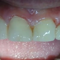 ترميم أسنان أمامية • حشوات تجميلية • مستشفى القياره العام