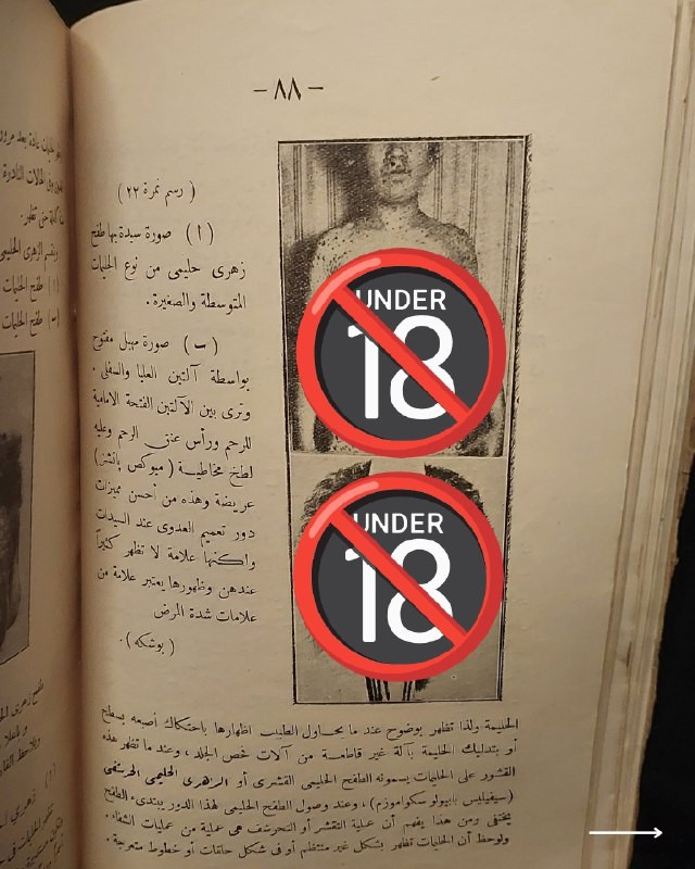 "مرجع طبي تراثي نادر في علم الأمراض السريرية والعلاجات الكلاسيكية!"
🌍
📜
🩺
🩸
📘
(كتاب الأمراض التناسلية وعلاجها وطرق الوقاية منها)
تأليف: الدكتور فخري (طبيب الجلد والأمراض التناسلية).
⚜️
📚
ناشر الطبعة: المطبعة العصرية ومكتبة الخليل لصاحبها خليل الخليلي - مصر
🇪🇬
.
✨
عن هذه النسخة التراثية:
سنة الطبع: 1960-1970
الحالة: ممتازة
✅
الموضوع:
كتاب طبي تاريخي وتخصصي رصين يستعرض بدقة علمية كلاسيكية منظومة الأمراض التناسلية والجلدية الشائعة وطرق تشخيصها السريري وعلاجاتها الدوائية والوقائية المعتمدة في القرن الماضي، يهم جداً أطباء الجلدية والتناسلية، طلاب كليات الطب والصيدلة، الباحثين في تاريخ العلوم الطبية، وهواة اقتناء المخطوطات والمراجع الطبية التراثية النادرة.
للحجز
🔻
:
البوت:
@PH_900bot
أو واتساب: ***********
