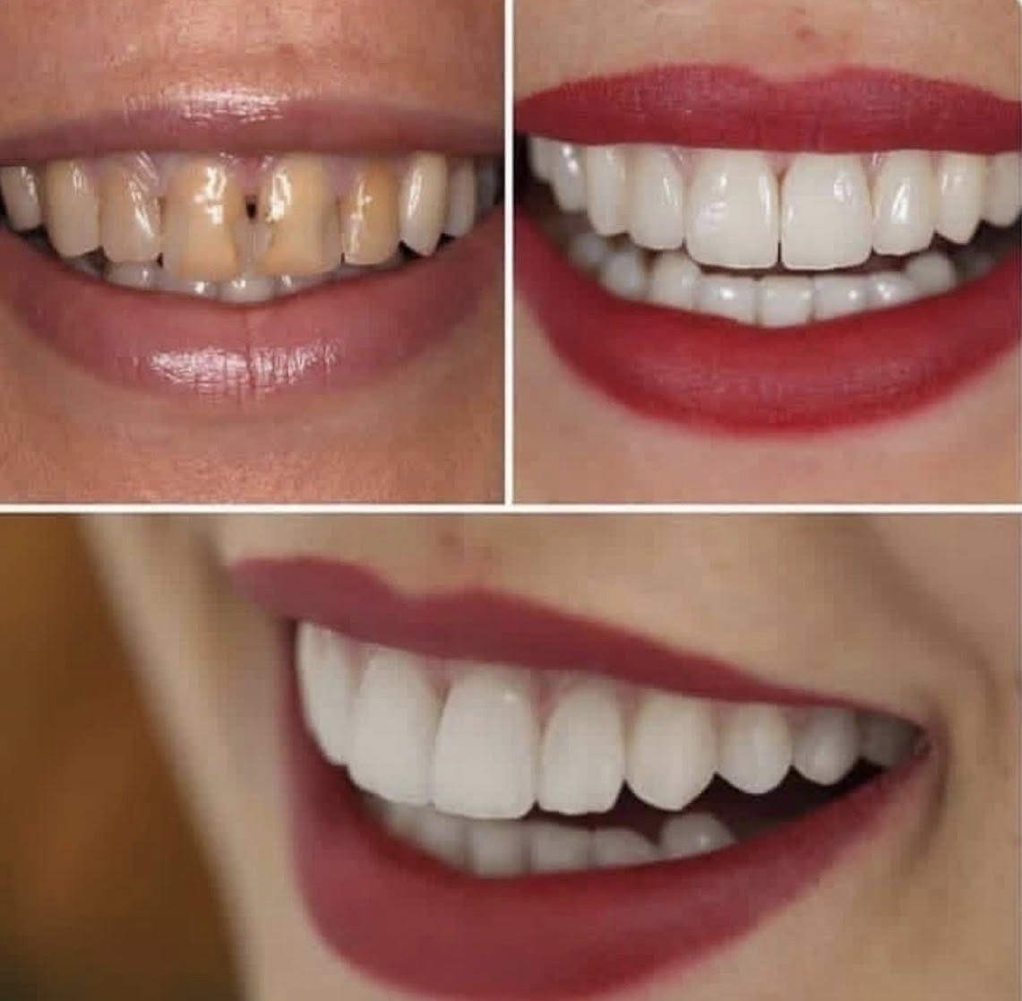 🔥🔥🔥العررررررررررررض 🔥🔥🔥الي ماله مثيل
العررررض الخرافي 💖
عررررررض الأحلام الي ماكو بغداد وكل العراق
العررررررض يمنه وووووبس 
وبعيادتكم المرموقه ♥️♥️
هسه صارت ابتسامة المشاهير 
بسعرررررر ؟مستحيل تصدكوه🤑
ولفترة محدوده ولعدد محدود من المراجعين
بدون برد
بدون ألم
بدون بنج 
وبجلسة واحدة فقط وساعة واحده و١٧٥ الف فقطططط

للحجز السريع
***********
انطلقووووووووووووو
العنوان : زعفرانيه اربع شوارع فوك لحم بعجين الزيتونه اكبال ابو علي منزليه
