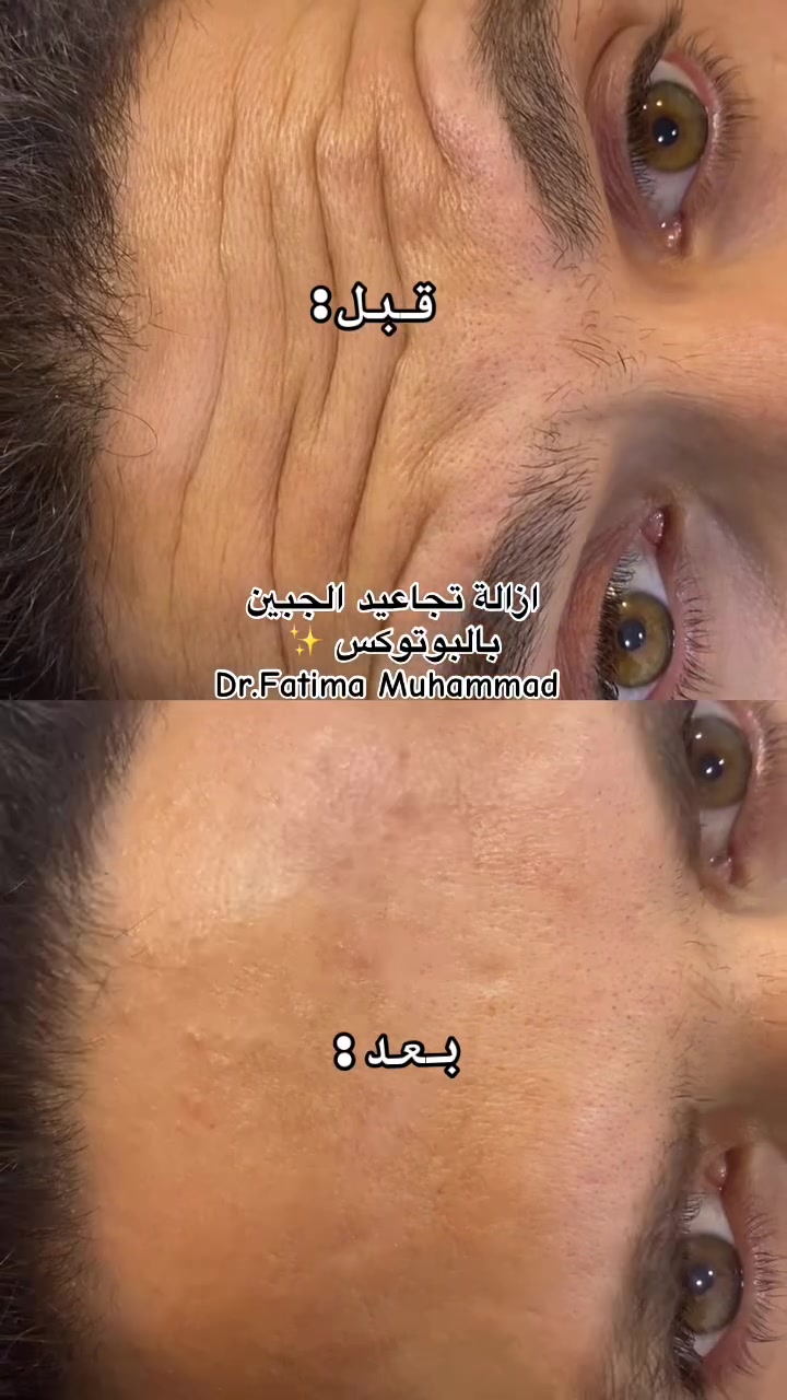 متوفر بوتوكس للإزالة تجاعيد الجبيين للحجز ***********
