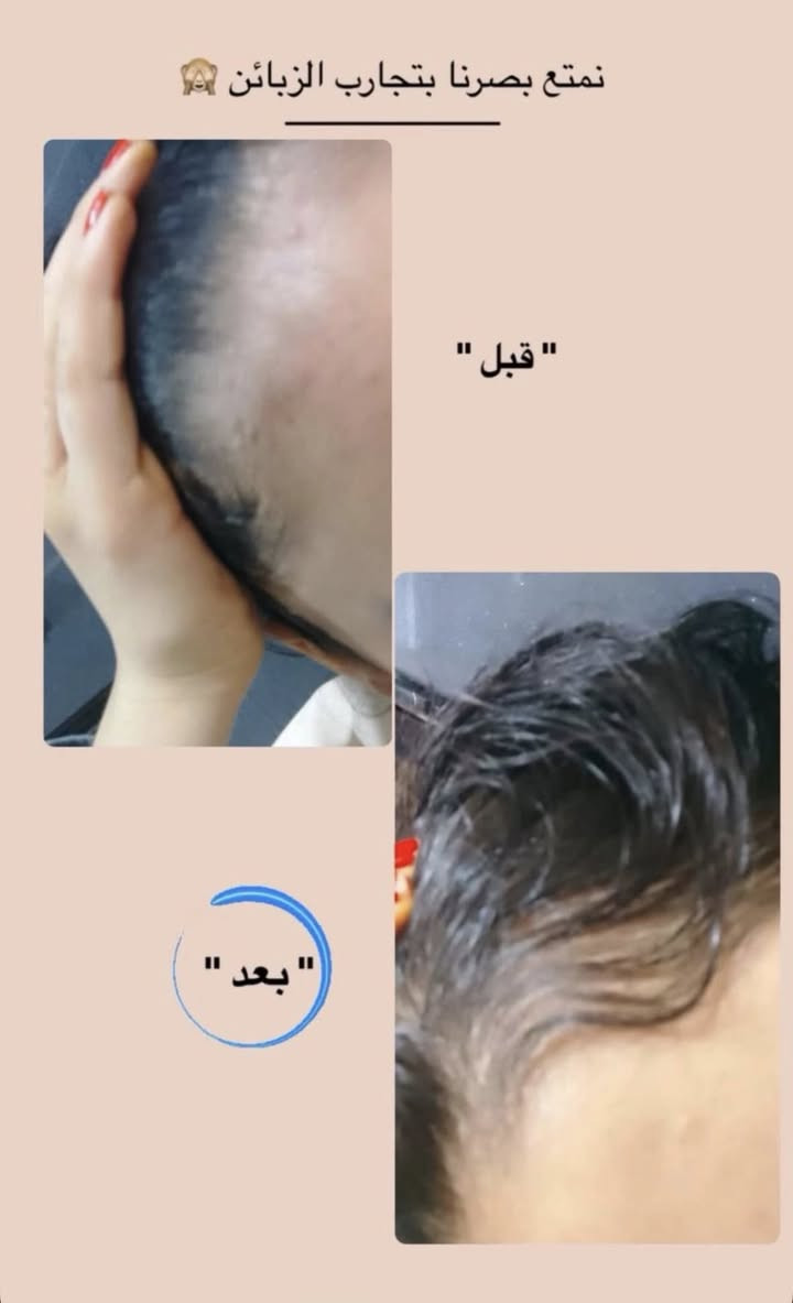 غأمانة الله كلمن تجي عينه عالمنشور يرفعه بكلمة ياالله..
الف رحمة على امة وابو اليعلق نخيت بس الكفو
الف رحمة ع والديكم العدلين والمتوفين هذا رزقي واذا خليتولي كم ملصق مياثر عليكم 
ولله العضيم اطيكم زيت للرجال وللنساء اذا  ماطول وقف التساقط وثخن شعررج فلوسج تررجع زيت بل عشاب يجنن وريحته  تخبل اخمره مده سبوع يلا ابيعه ينطي مفعول اكثر 
تدعلي واني حلفت بعد
 هاي نتيجه شعري ونبي يجنننن وعن تجربة وربي ويبقه ذمة بركبتي اذا مفادكم اجاوب كلشي ؏ خاص ولله العظيم كل فلس بي يسوه
توصيل مجاني وشرط اذا مو نفس النتيجة التردوها ترجع فلوسكم ولله


**إذا كنت صاحب هذا الإعلان وتريد حذفه لأي سبب، رجاءا أرسل رسالة إلى الدعم الفني**