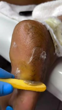 مادة الكالوس • عناية الأقدام • مستحضرات تجميل