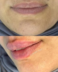 فيلر شفايف • نتيجة فورية • المحمودية