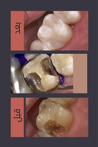 #حشوة_ضوئية معالجة تسوّس السن الخلفي وتبديل الحشوة القديمة بحشوة ضوئية...