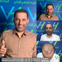 زراعة شعر • سفير ٧٠٠٠ بصيلة • ضمان مدى الحياة
