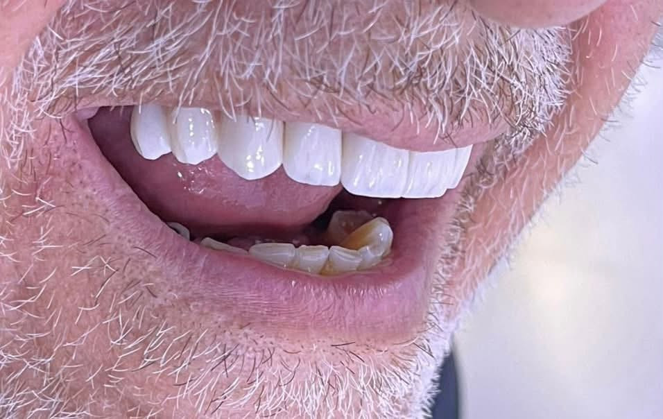 ابتسامه جديده لمراجعنا 🦷

تعويض الأسنان المفقوده وتركيب أسنان الزاركون الثابته 
اعادت للمريض الأبتسامه الطبيعيه ووظيفه المضغ 

ابتسامه صحيه  ومتناسقه 🔥🔥

‎العنوان : قلعة سكر - شارع الاطباء - بجانب صيدلية النبراس (مجمع الكواظمة / الطابق الثاني)
‎للحجز والأستفسار 📞 ***********
‎او مراسلة الصفحة
