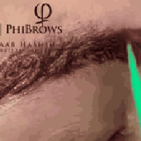 إزالة تاتو • في ريموفل • المحمودية الرشيد