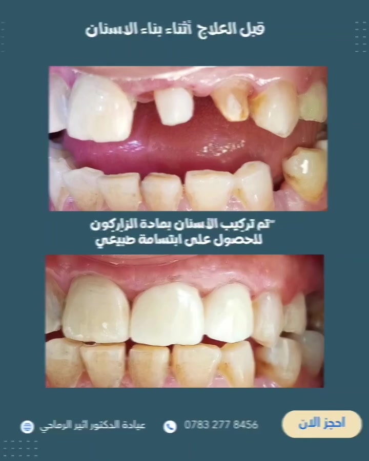 لأن التفاصيل تصنع الفرق..
"تمت إعادة تأهيل الابتسامة بتركيبات الزيركون بدقة عالية، للحصول على مظهر طبيعي أنيق يعكس الثقة والجمال." ✨🤍

 (عيادة الدكتور أثير حليم الرماحي) 

☎️ للحجز والاستفسار ***********
او مراسلة الصفحة

📍 الموقع: 
الديوانية- قضاء عفك/شارع الأطباء قرب صيدلية أكرم البديري بناية الدكتورة مروة حمود التميمي الطابق الثاني

#ابتسامتك_تستحق_الأفضل
#دکتور_اسنان #قضاء_عفك
#تركيبات_أسنان_زاركون #حشوات_تجميليه_حشوات_جذر_قلع_جراحي
