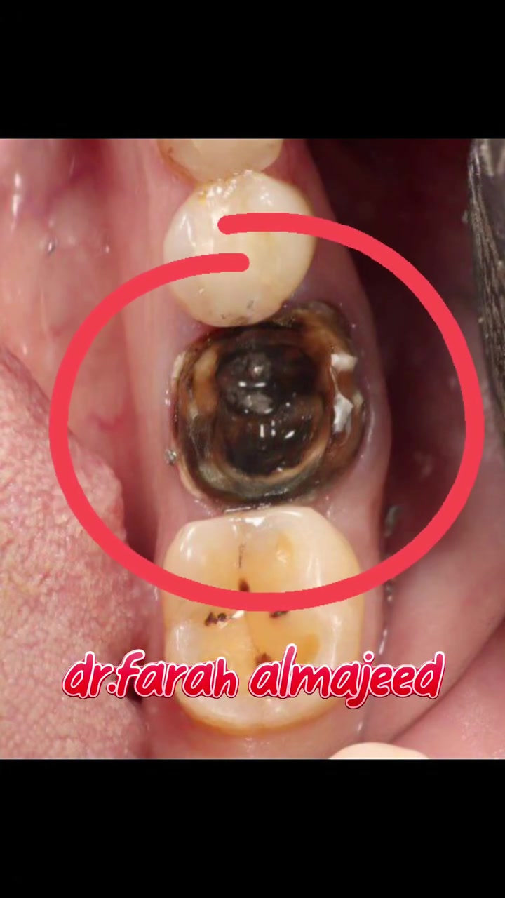 👈تجميل الأسنان هو الروتين للشغل اليومي بالعيادة 🤩💯
👈تم ارجاع الشكل والوظيفه للاسنان بيد دكتورة فرح اختصاص+ خبرة ١٤ سنه بالعمل 
بعقوبة🌿 مدخل شفته الرئيسي
***********☎️
