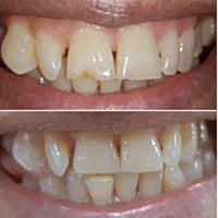 تم معالجة القاطع العلوي باستخدام الحشوات التجميلية المتابعة المبكرة وا...