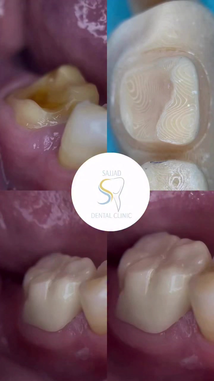 عندك هيج سن لا تفكر تقلعه ابد ،، بكل بساطة يرجع احسن من قبل ⁨ ⁨ ⁨ ⁨ ⁨ ⁨ ⁨ ⁨ ⁨ ⁨⁨ ⁨ ⁨ ⁨ ⁨ ⁨ “الدكتور سجاد حسين الطائي 
بكالوريوس طب وجراحة الفم والأسنان … #تعويض_الأسنان 

العزيزية - شارع الأطباء، مقابل كوزمتك هايدي 
للحجز والاستفسار: 
*********** 
*********** 
أوقات الدوام: من 3:30 إلى 9:00 مساءً، جميع أيام الأسبوع.⁩⁩⁩⁩⁩⁩⁩⁩⁩⁩⁩⁩⁩⁩⁩⁩⁩⁩⁩
