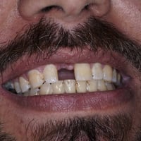 ابتسامة جديدة • زركون • المسيب