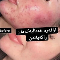 حلبجة • هيدروفشيال • ميزو