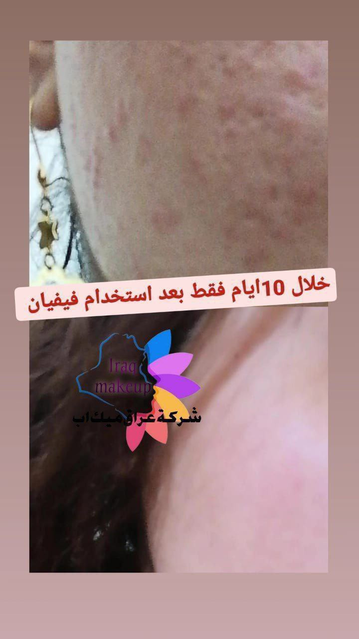 نتائج فيفيان الكل يحسدج عليها 💖🌸
توحيد ونضارة ولمعة وعلاج للتصبغات وتصحيح للبقع الداكنة ...
تواصلي ويانا لاستشارة مجانيةكريم فيفيان

❄️ احد اهم افضل المنتجات لتبييض البشرة ❄️
.
 🎗منتج واحد يساعد علئ حل اهم 5  مشاكل للبشرة 🎗
.
يبيض البشرة - يعالج الكلف - يعالج التصبغات - يعالج الهالات التحت العين - يرطب البشرة وتصبح اكثر نضارة 
.
.
نتيجة الكريم ثابتة ودائمية 🟢 نتائج حقيقية من اول  استخدام 🟢 بدون اثار جانبية اثناء  او بعد ترك الاستخدام  بسبب التركيبة العشبية ⭐️
#عناية_طبيعية #بشرة_صحية #عناية_بالبشرة #ترطيب_البشرة


**إذا كنت صاحب هذا الإعلان وتريد حذفه لأي سبب، رجاءا أرسل رسالة إلى الدعم الفني**