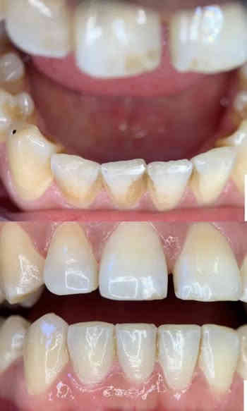 اعلااان🏅

السلام عليكم
بعد الانقطاع بسبب عطله الانتخابات
عياداتنه رجعت من جديد 
جاهزين لارجاع ابتساماتكم  والضحكه الحلوه على وجوهكم الجميله

وبشكل مجااااني

شنو الحالات الي نشتغلها؟
١-حشوات تجميليه ضوئيه
٢-تنظيف وازاله التكلسات والتصبغات
٣-قلع الاسنان التالفه او الجذور المتبقيه
٤-تعويض الاسنان المفقوده بطقم

موقعنا: كربلاء - حي الموظفين- خلف مشفى الولاده- عيادات جامعه كربلاء

زين انتو طلاب وجاي تطبقون بينه وتتعلمون مو صح!!

هاي جانب من شغل طلابنا شوف واحكم بنفسك.

للتواصل:***********
