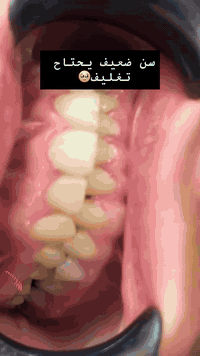 تغليف الاسنان الضعيفة او الي تحوي حشوات كبيره حته نحافظ عليها من الكسر مستقبلا 🌸⚡️

تغليفات الايماكس تتميز بالشكل الطبيعي والمماثل لشكل الأسنان الحقيقي والقوه والمتانه ⚡️⚡️🔋

شوفو الحاله ونطونه رأيكم 😍
 كل خدمات طب الأسنان تحت سقف واحد وبنظام الاقساط على بطاقة كي كارد المصرفية 🥰🪪🪪

📞 احجز موعدك الآن وابدأ أول خطوة نحو ابتسامة جديدة🔥🔥

@hygienic_dentalclinic 
_____________________
للاستفسار التواصل خاص 
او الاتصال على الرقم/واتساب 📱☎️
*********** 
العنوان الحرية شارع المشجر مجاور الضريبة مقابيل مرطبات الساقي 
#الحرية_الاولى #مدينة_الحريه_الحبيبه #الحرية_شارع_باتا #الحرية_شارع30 #اكسبلور #تقويم_الأسنان #الحريه_ #تقويم_الأسنان #الحريه_ #التقويم_الشفاف✨ #تقويم_الأسنان #عياده_هايجنك_تهتم_بصحه_اسنانكم #الحريه_ #زراعه_الأسنان
