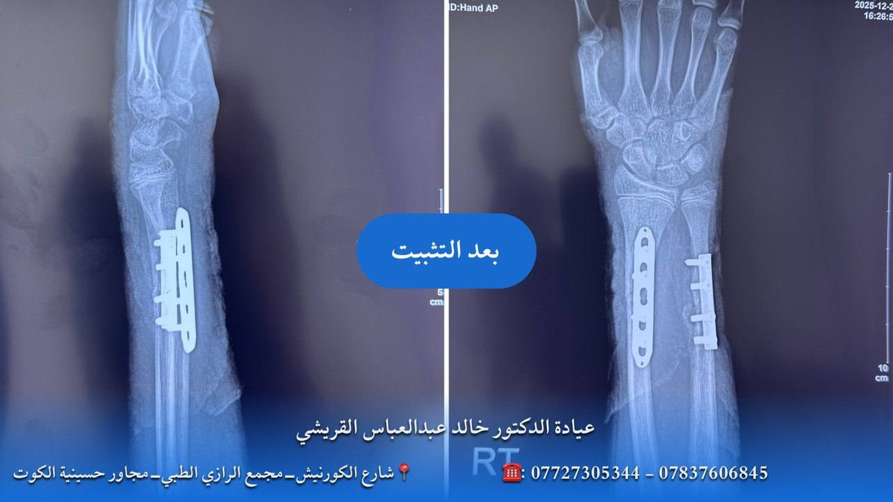 تثبيت كسر عظمي الساعد ( القعبرة والزند) لمريض عمره ١٥ عاماً، تعرض الى الكسر اثناء حادث سير 
علماً إن الكسر مضى عليه اكثر من شهر!
أجريت العملية في مستشفى الكرامة التعليمي

الدكتور خالد عبدالعباس القريشي
🩺-اخصائي جراحة العظام والكسور والمفاصل
🩺-تبديل مفاصل (الورك والركبة)
🩺-تثبيت الكسور المعقدة بالطرق الحديثة
🩺﻿-جراحات تشوهات الاطراف الولادية وخلع الورك الولادي
🩺﻿-علاج الاصابات الرياضية وإصابات العمود الفقري
🩺-علاج القدم السكري
ارقام الحجز:
☎️***********
☎️***********
📝العنوان:
الكوت-شارع الكورنيش-مجمع الرازي الطبي-مجاور حسينية الكوت
