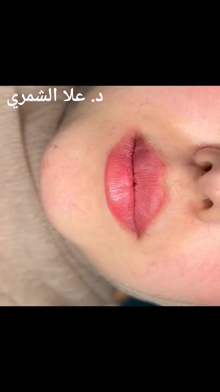 من #ضمن_عمل_الدكتوره_علا_الشمري
بدون رسم وحدود ==صارت ب رسم وحدود ب 1 سيسي فلر
د.علا هادي الشمري 

6*********** ‏📞
💋💋💉
#explore #explorar #explorer #lip #lipfillers
_____________________
رابط الصفحه تابعوا شغله نظيف
https://www.facebook.com/profile.php?id=61557796116855

#بنات_الكوت_التجميل_جلسات_فلر
#دليل_التجميل_الكوت
