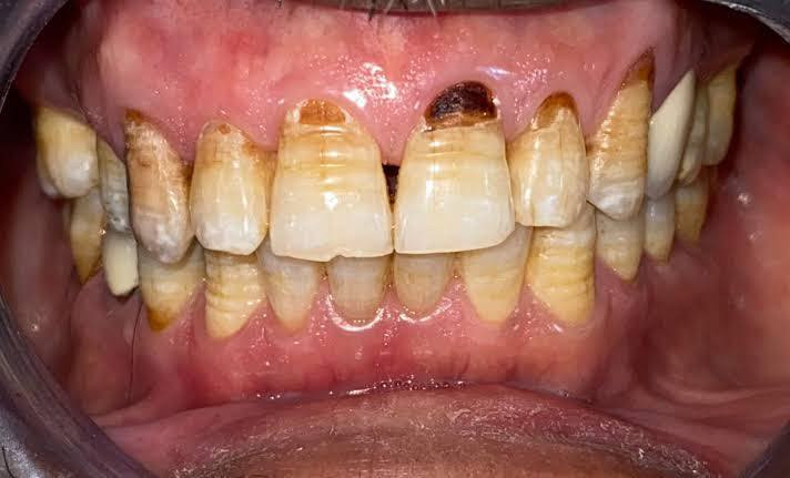 مجاناً مجاناً
العنده هيج اماكن متسوسة او مكسورة ب أسنانه مثل صور
يتواصل خاص او مع الرقم 
***********
الموقع الإسكان عيادات جامعة الكفيل
