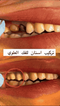 تلبيس الأسنان • تركيبات زركون • الشامية البلداوي