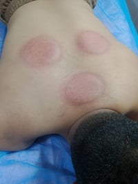 حجامه اهل البيت (ع) شفاء الجرح بعد الحجامه مباشر استعمال كؤس الحجامه م...